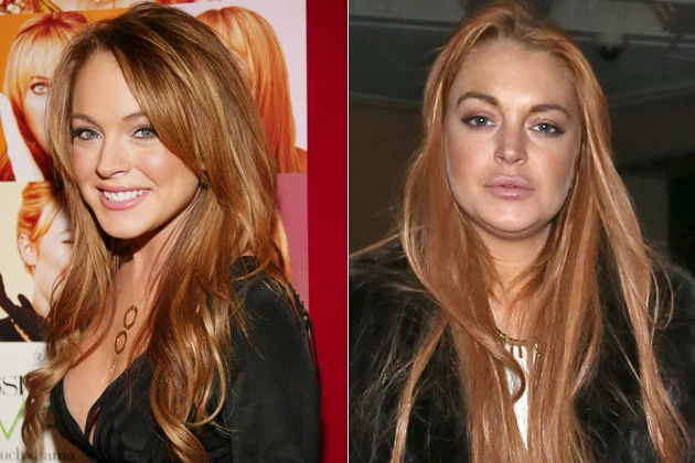Lindsay Lohan's plastic surgery - before and after Lindsay Lohan's plastic surgery - before and after