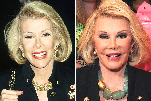 joan-rivers-plastic-surgery joan-rivers-plastic-surgery